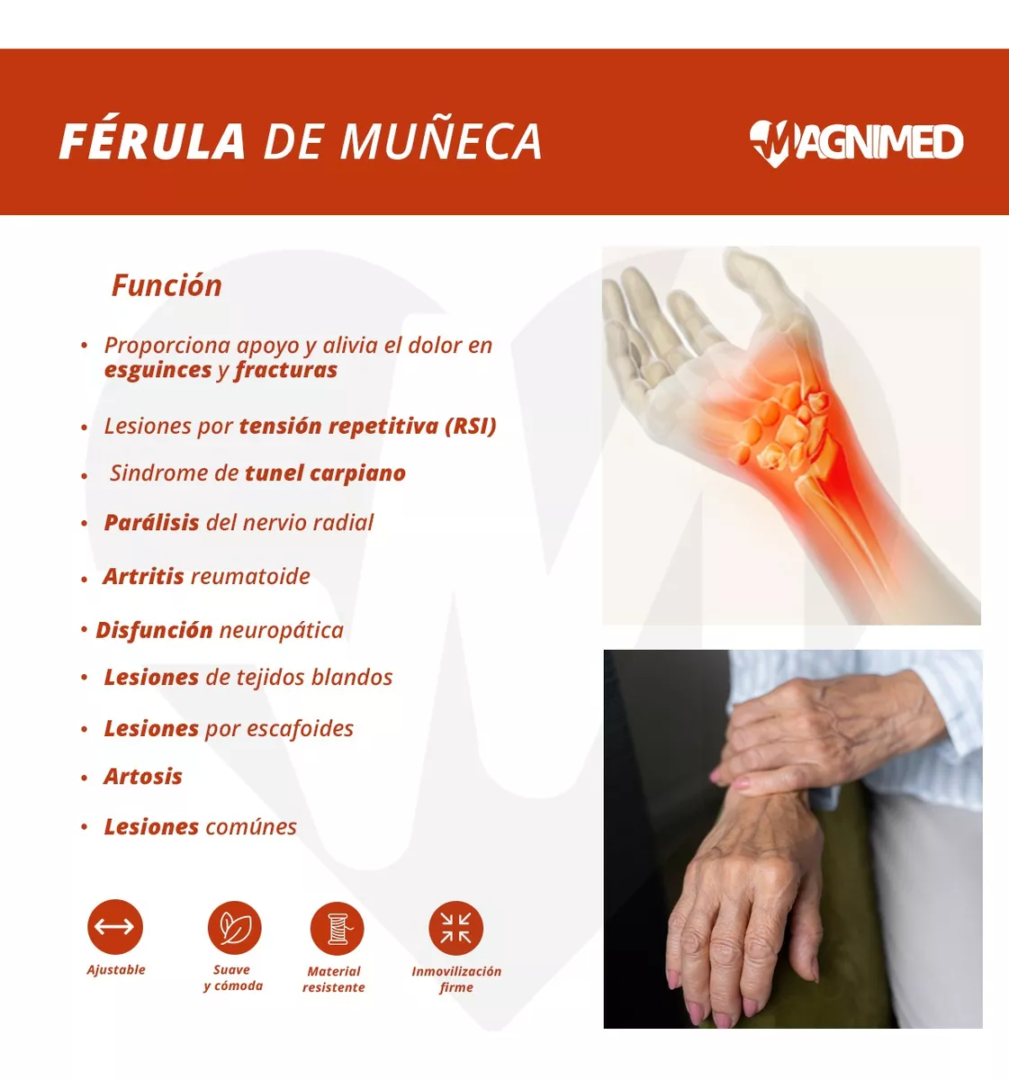 Parálisis del nervio radial